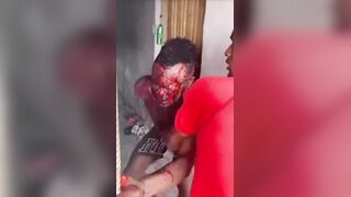 Man Lost An Eye After Getting Stabbed During Domestic Dispute