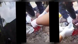 Coconut Collector Suffers Open Fracture