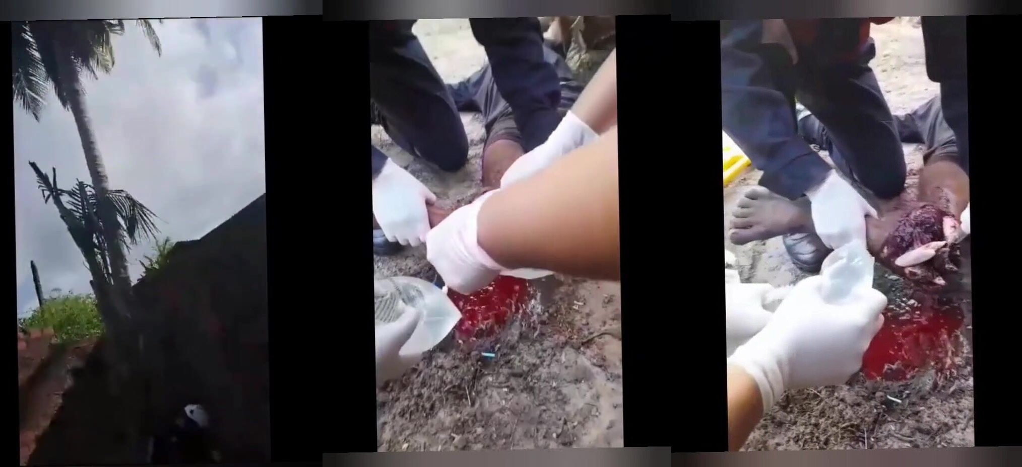 Coconut Collector Suffers Open Fracture