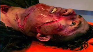 Meat Cleaver Face & Throat Slash — Still Conscious on the Gurney