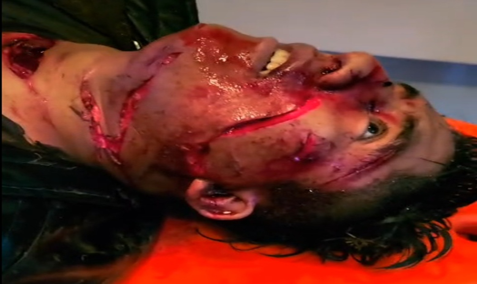 Meat Cleaver Face & Throat Slash — Still Conscious on the Gurney