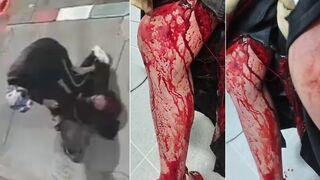 University Student Stabbed Multiple Times in Both Legs After Resisting Robbery