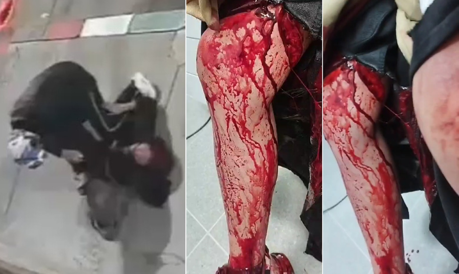 University Student Stabbed Multiple Times in Both Legs After Resisting Robbery