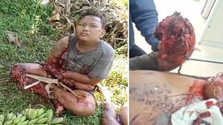 Severed Hands & Severe Wounds: Explosion Rocks Trio Making Illegal Explosive Firework