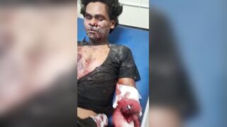 Severed Hands & Severe Wounds: Explosion Rocks Trio Making Illegal Explosive Firework