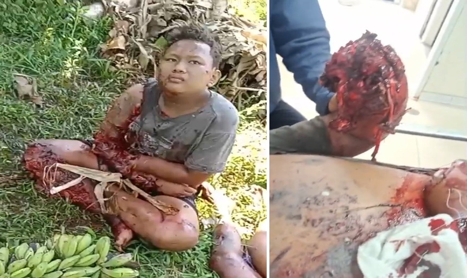 Severed Hands & Severe Wounds: Explosion Rocks Trio Making Illegal Explosive Firework