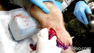 A Russian man is having flesh amputated from his leg without anesthesia