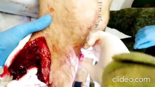 A Russian man is having flesh amputated from his leg without anesthesia