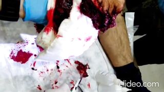 A Russian man is having flesh amputated from his leg without anesthesia