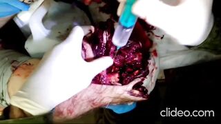 A Russian man is having flesh amputated from his leg without anesthesia