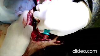 A Russian man is having flesh amputated from his leg without anesthesia