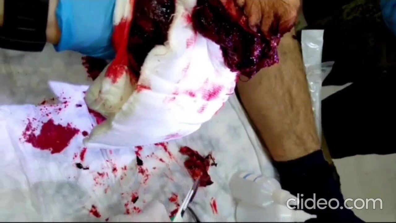 A Russian man is having flesh amputated from his leg without anesthesia