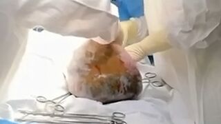Shockingly large tumor