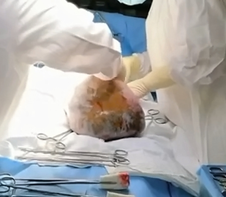 Shockingly large tumor