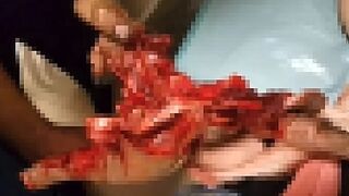 (2018)Young Russian Man's Hand Torn Off by Firecracker