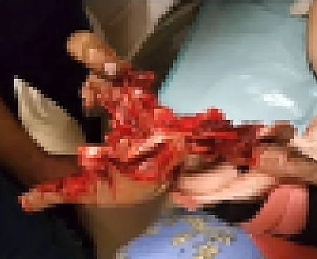(2018)Young Russian Man's Hand Torn Off by Firecracker