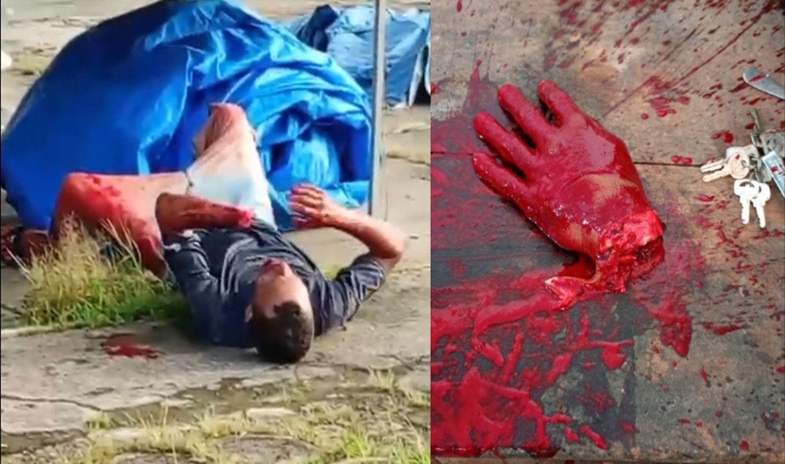Man with Mental Breakdown Severs His Own Hand with Machete and Collapses in Agony