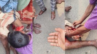 Truck accident peels mans skin back