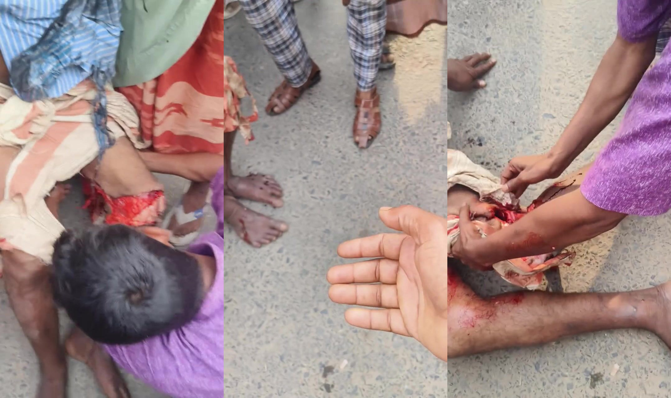 Truck accident peels mans skin back