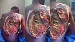 WTF- Black man with severe 4th degree burns lost a chunk of his flesh (Organs exposed