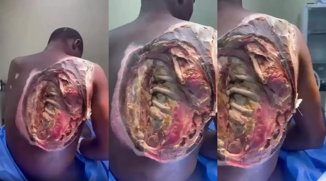 WTF- Black man with severe 4th degree burns lost a chunk of his flesh (Organs exposed