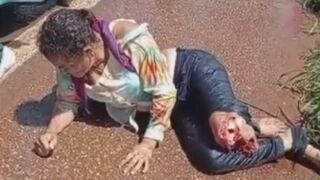 Woman Suffers Terrible Leg Injury Fully Awake