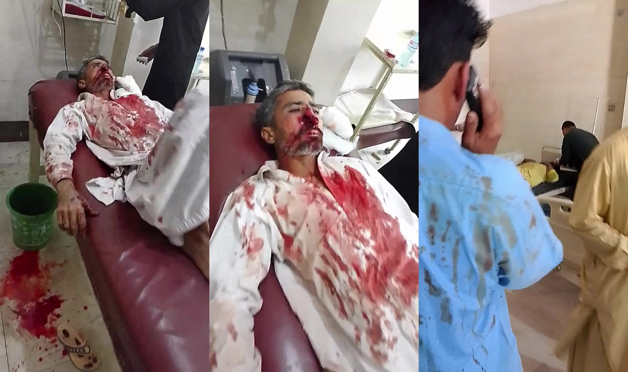 Nose obliterated in accident