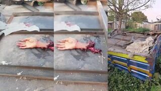 Hand severed in traffic accident