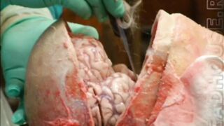 Autopsy Photos