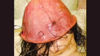 Autopsy Photos
