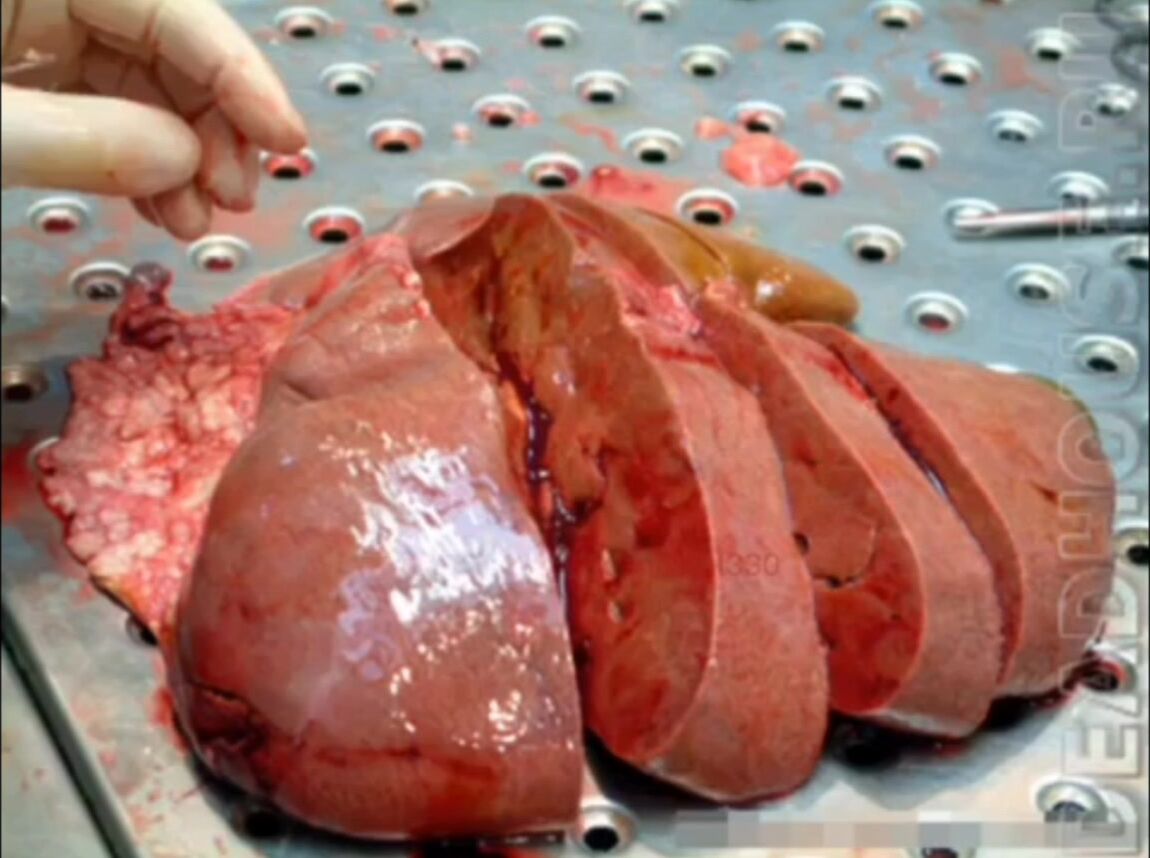 Autopsy Photos