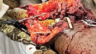 Shocking: RPG-7 ammunition penetrates the body of a UA soldier