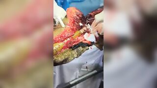 Shocking: RPG-7 ammunition penetrates the body of a UA soldier