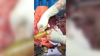 Shocking: RPG-7 ammunition penetrates the body of a UA soldier