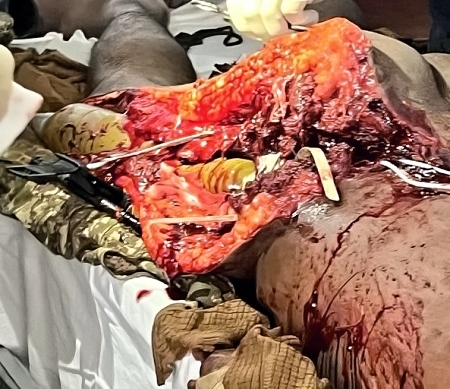 Shocking: RPG-7 ammunition penetrates the body of a UA soldier