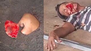 Worker Loses Part of Face and Arm in Gas Cylinder Explosion While Cutting It in Half