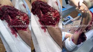 Terrible wounds on a Russian soldier’s arm and leg