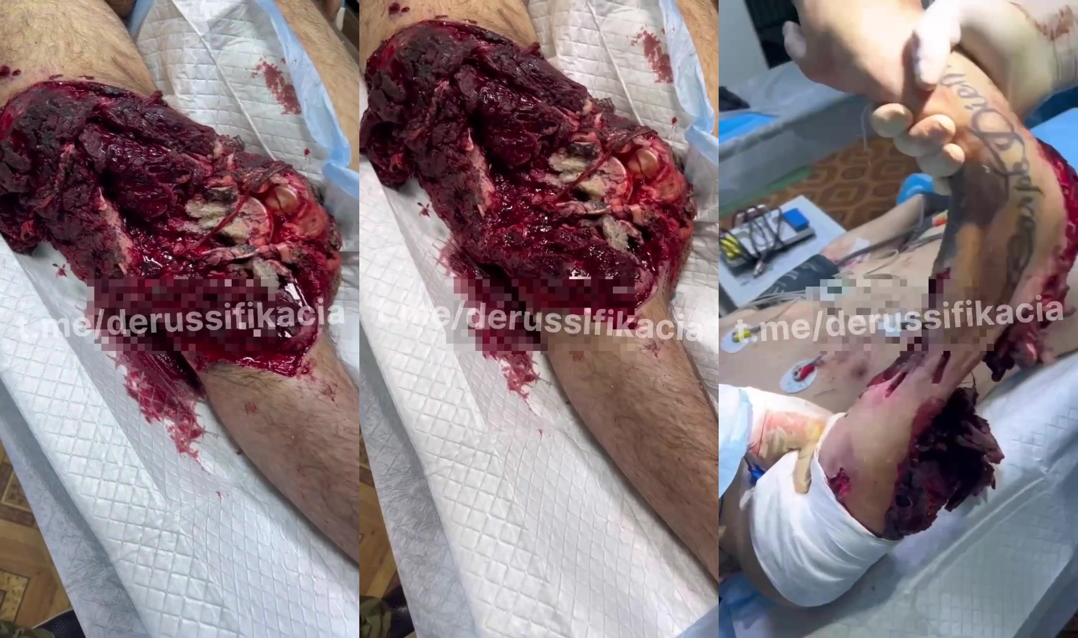 Terrible wounds on a Russian soldier’s arm and leg