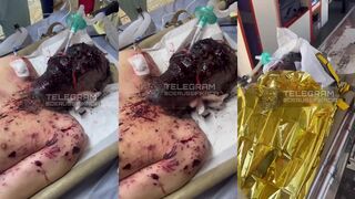 A Russian burnt soldier with shrapnel wounds