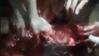 Brain removed by hands in Brazil