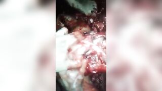 Brain removed by hands in Brazil