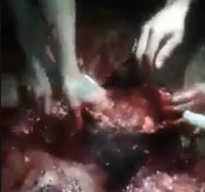 Brain removed by hands in Brazil
