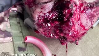 A Russian soldier sustained a head wound