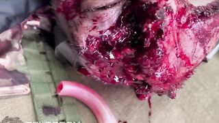A Russian soldier sustained a head wound
