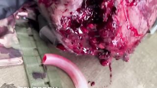 A Russian soldier sustained a head wound