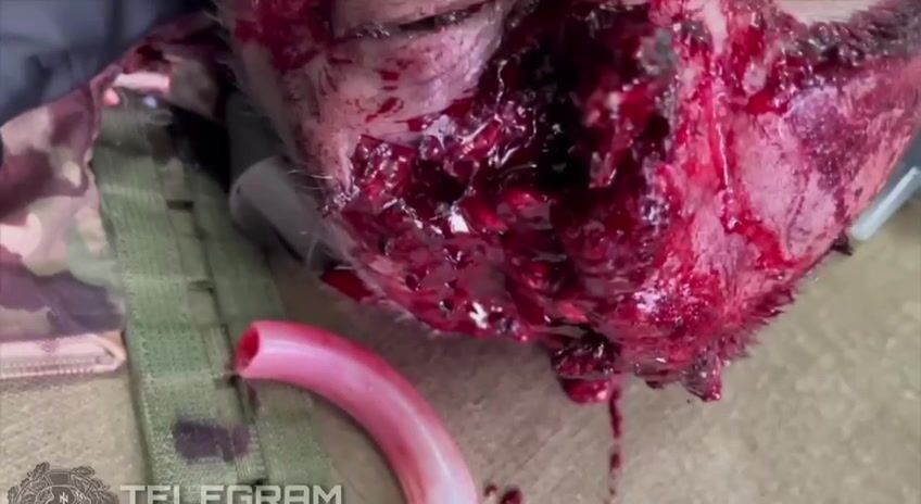 A Russian soldier sustained a head wound