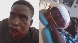 Man Shot In Mouth Survives Yesterday`s Massacre Of Christains By Boko Haram