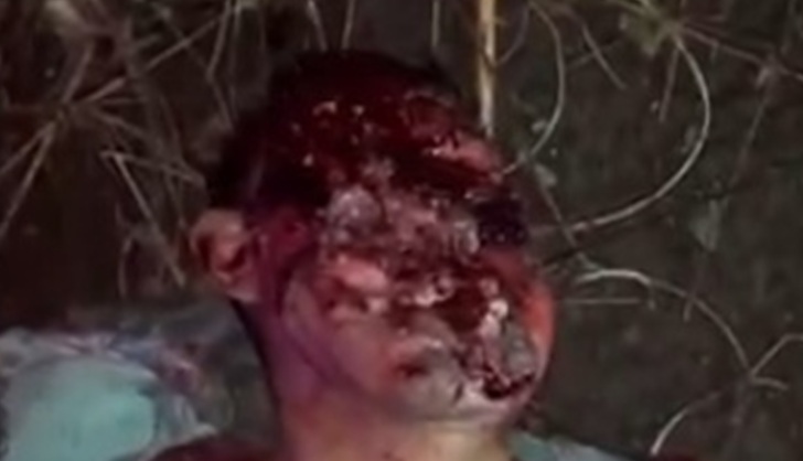Motorcyclist with Deflated, Flattened Face in Extreme Agony – Still Alive