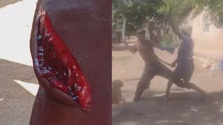 Man Seriously Injured During Machete Fight