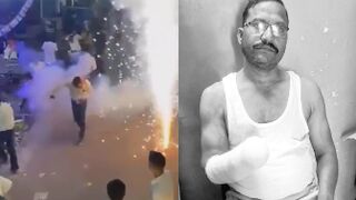 Man Loses Palm After Firework Explodes In His  Hands